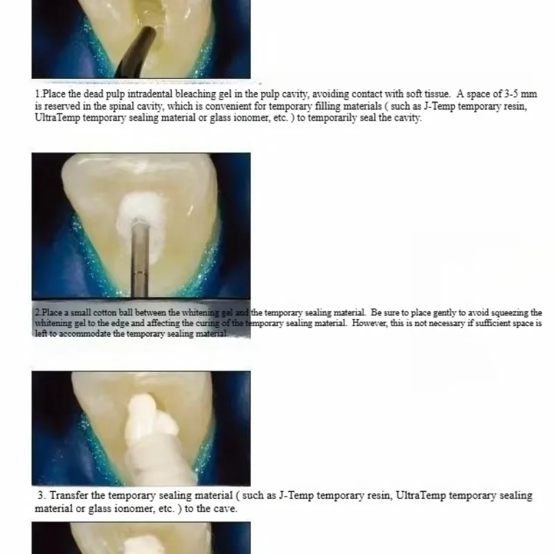 Dental Oral Restoration Materi - Teeth Whitening Effects recensione e prezzo