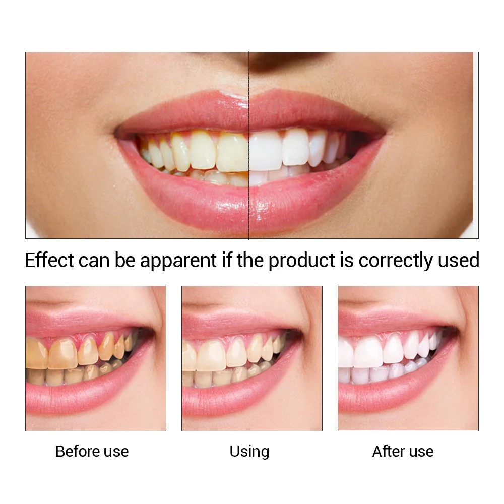 FTEENPLY Teeth Whitening Essen - Teeth Whitening/Bleaching recensione e prezzo