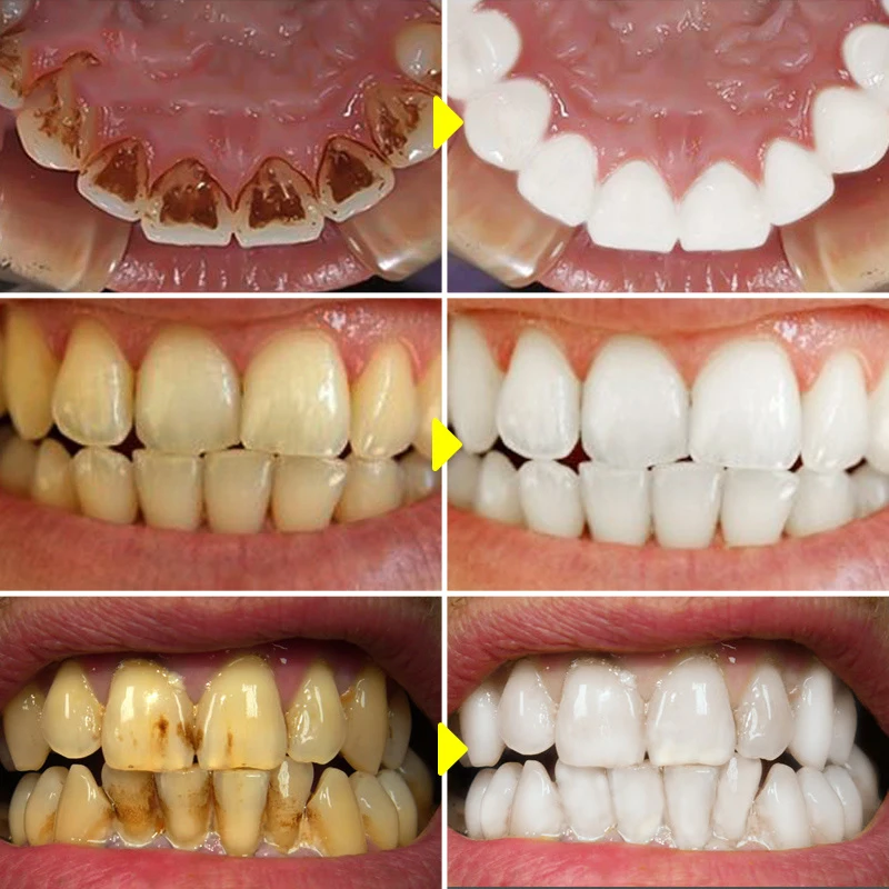 V34 Teeth Whitening Mousse Too - Teeth Whitening/Bleaching recensione e prezzo